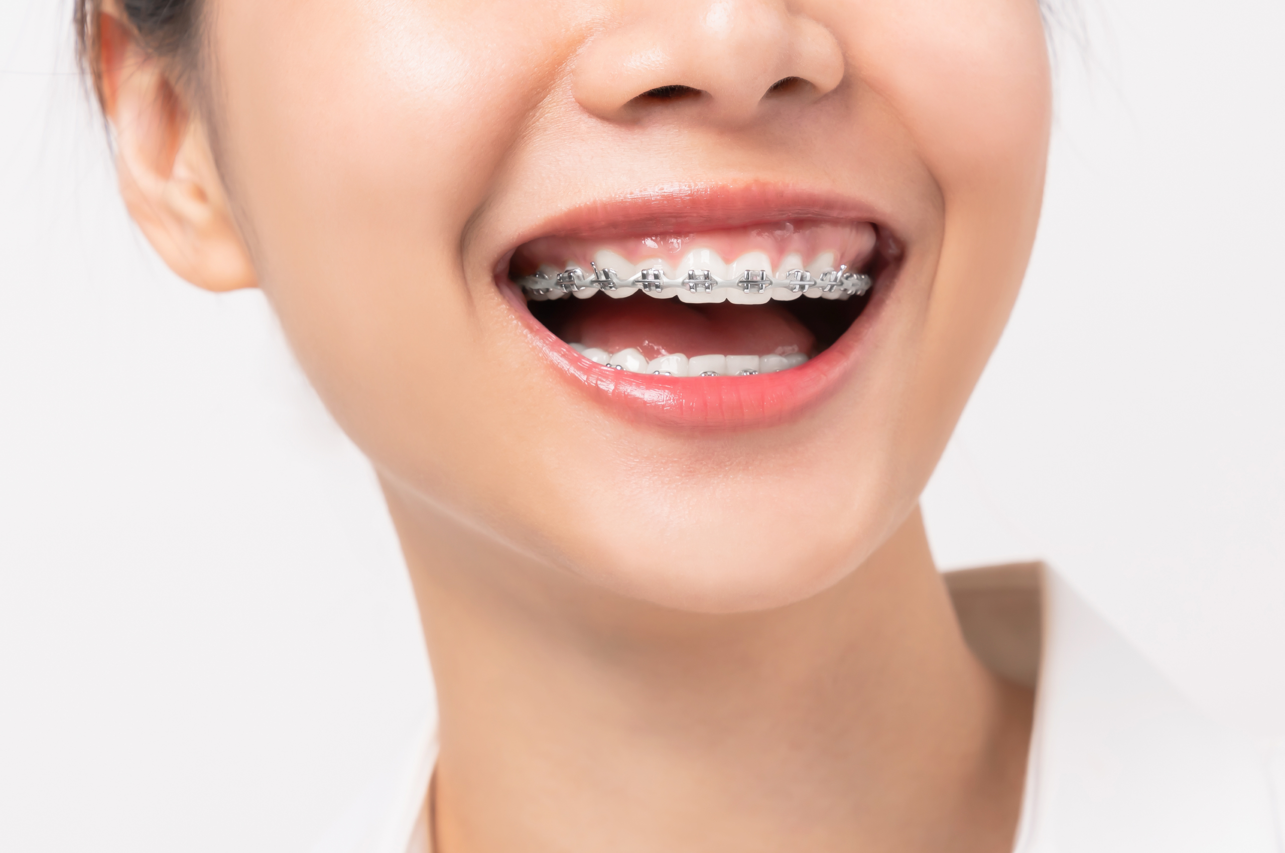 How do orthodontists bond braces to teeth? « Smiles by White