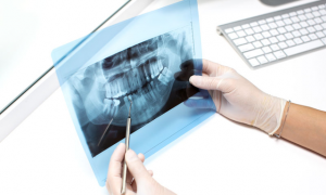 X-Rays can help visualize Wisdom Teeth