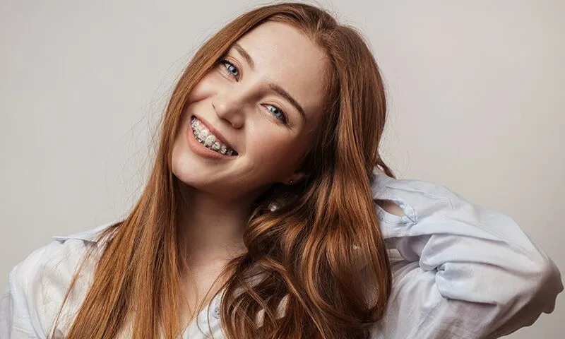 Ceramic (Clear) Braces